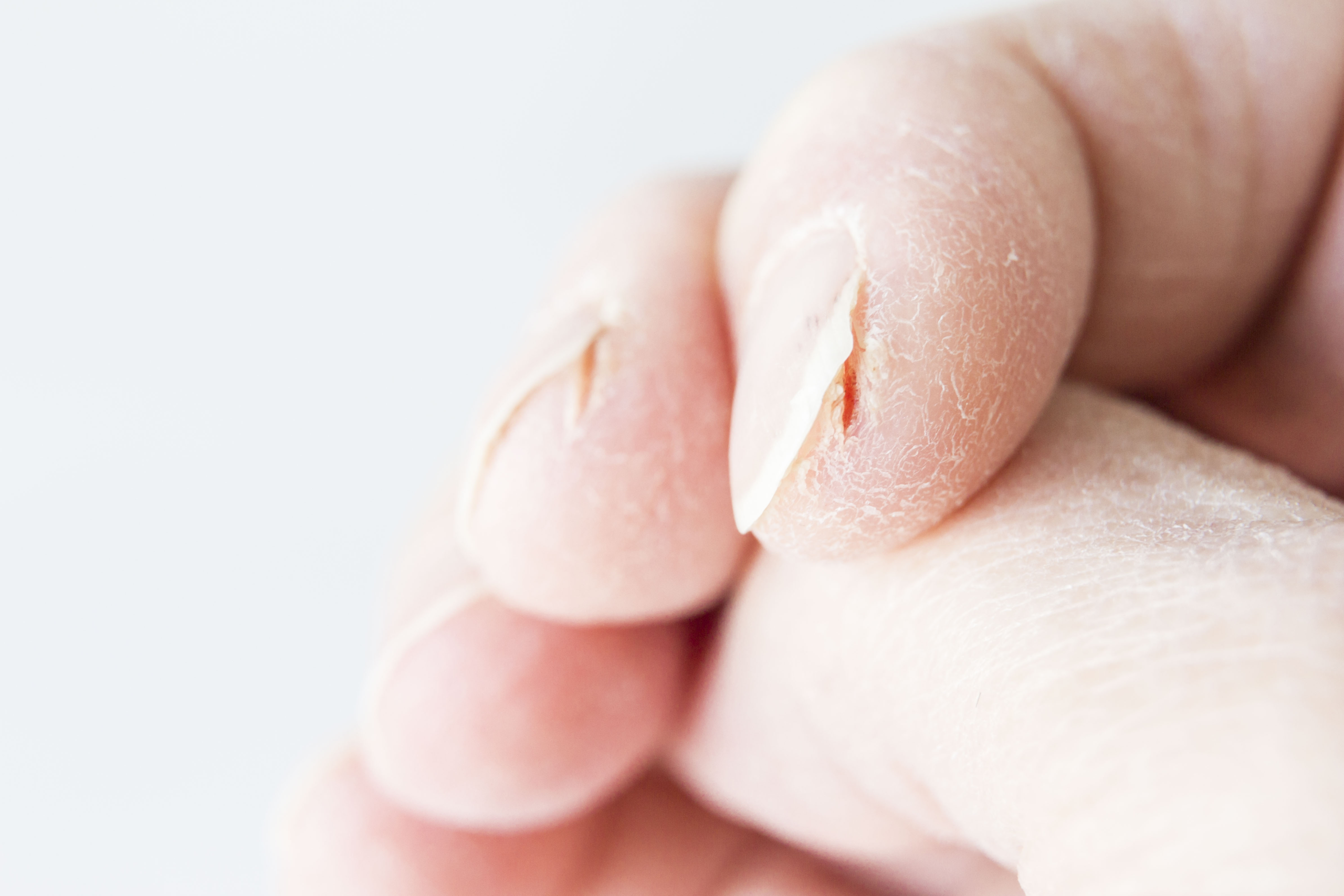 Cracked skin